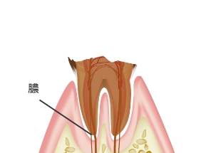 C4：むし歯の末期症状